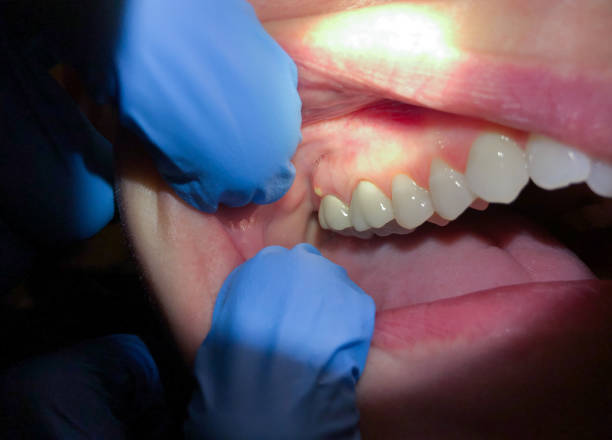Best Dentist for Tooth Abscess  in St George, UT