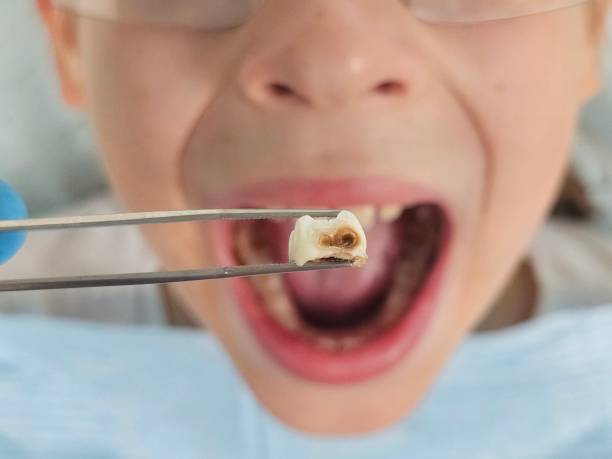 Dentist for Dental Trauma in UT
